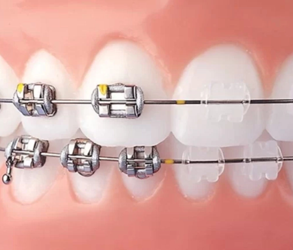 Bọc răng sứ có niềng được không? Khi nào nên niềng răng sau khi bọc sứ?