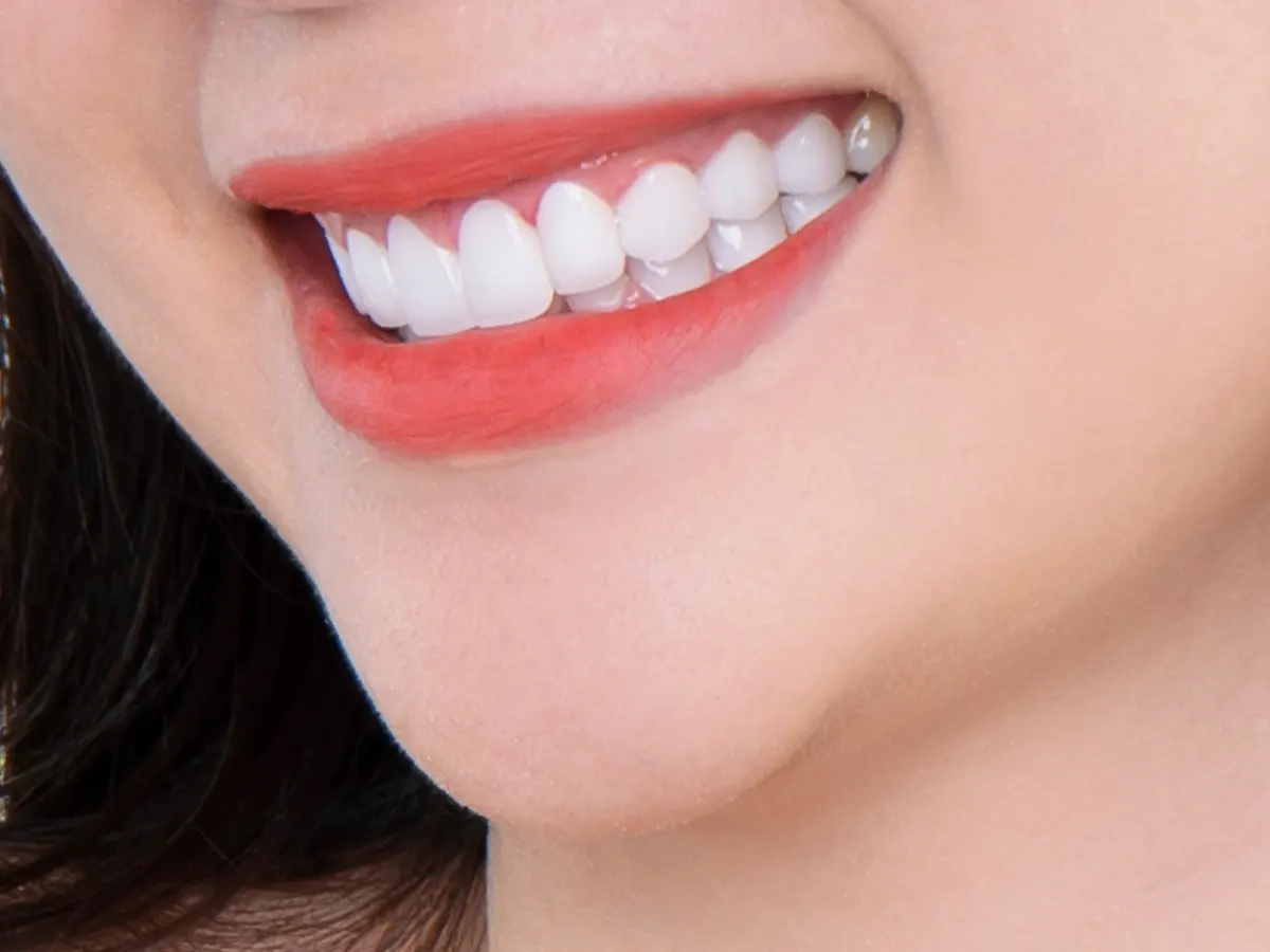 Răng Toàn Sứ HT Smile - Ưu điểm 1
