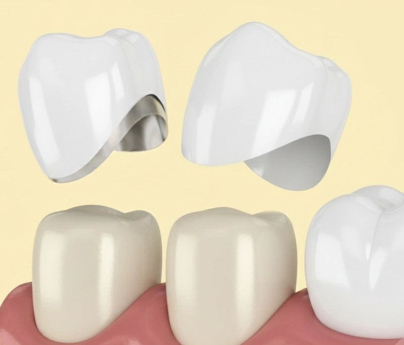 So sánh răng sứ Titan và răng toàn sứ: Loại nào tốt nhất?