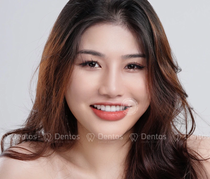 So sánh Tẩy trắng răng và Bọc răng sứ: Giải pháp nào tối ưu?