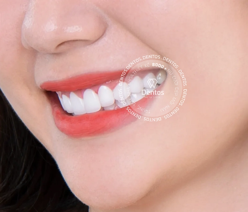 Cách chăm sóc răng sứ chuẩn nha khoa giúp bền đẹp trọn đời