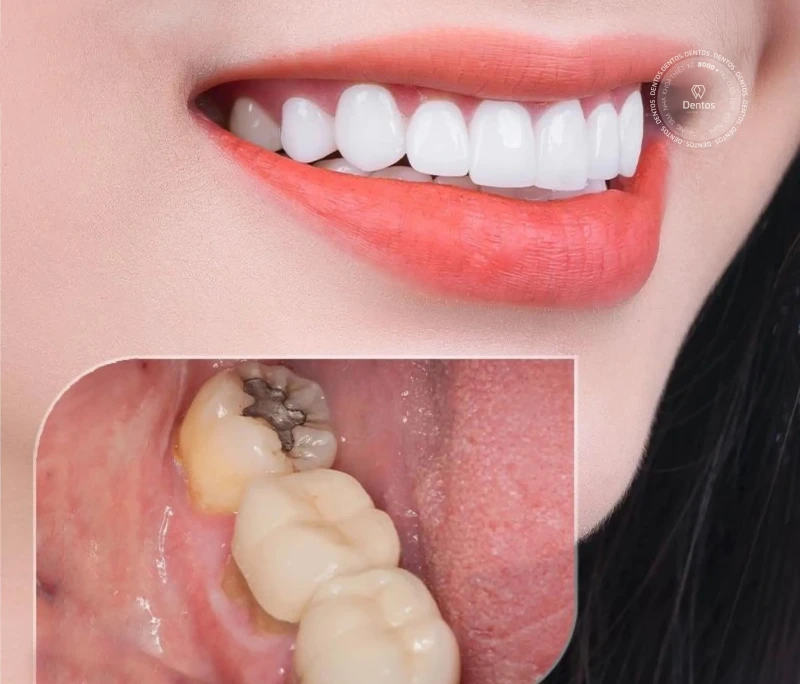 Tìm hiểu giá bọc sứ răng sâu bao nhiêu tại Dentos?