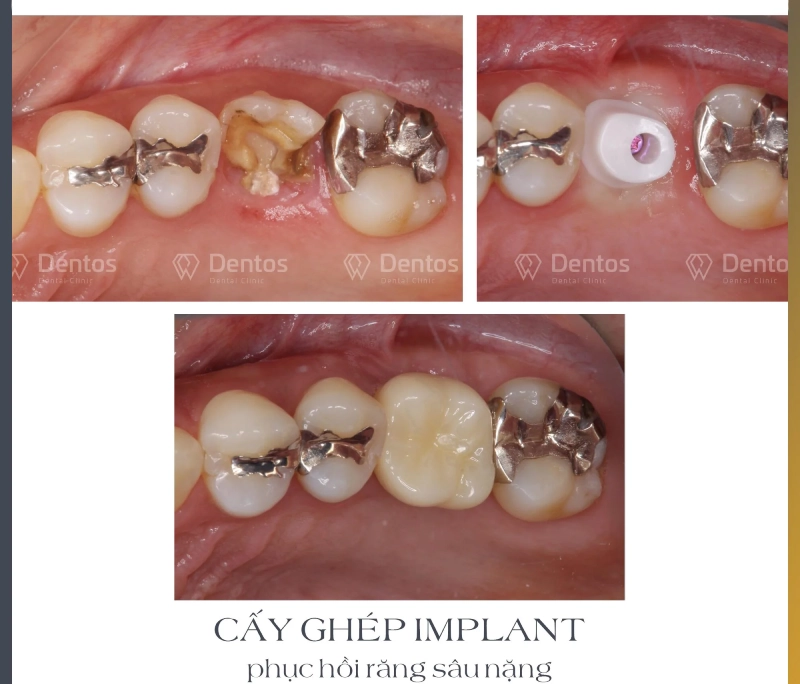 Implant Thụy Sỹ có tốt không? Tìm hiểu về trụ Implant Straumann SLA