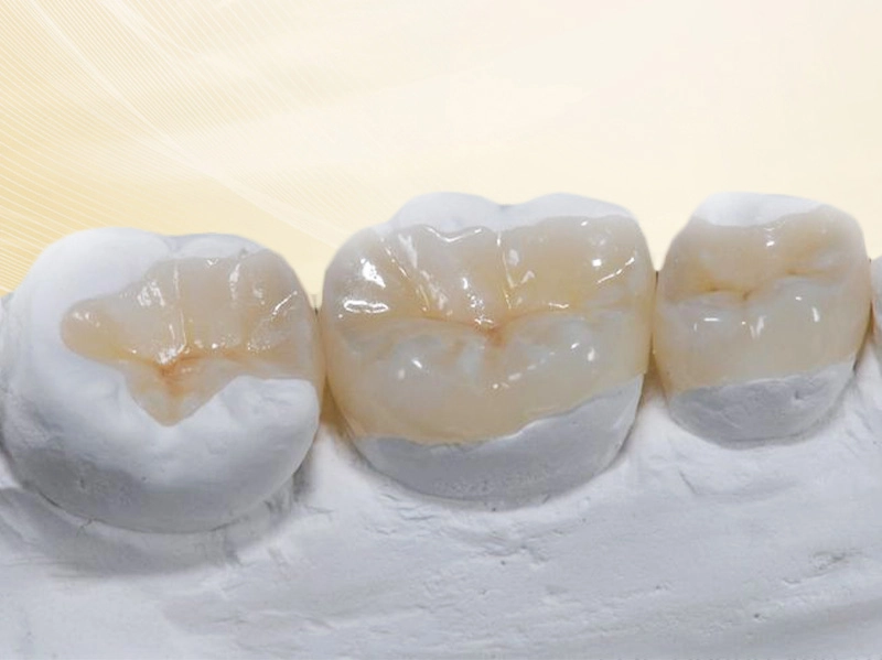 Trám Composite: Giải Pháp Vàng Cho Sâu Răng Chưa Biến Chứng