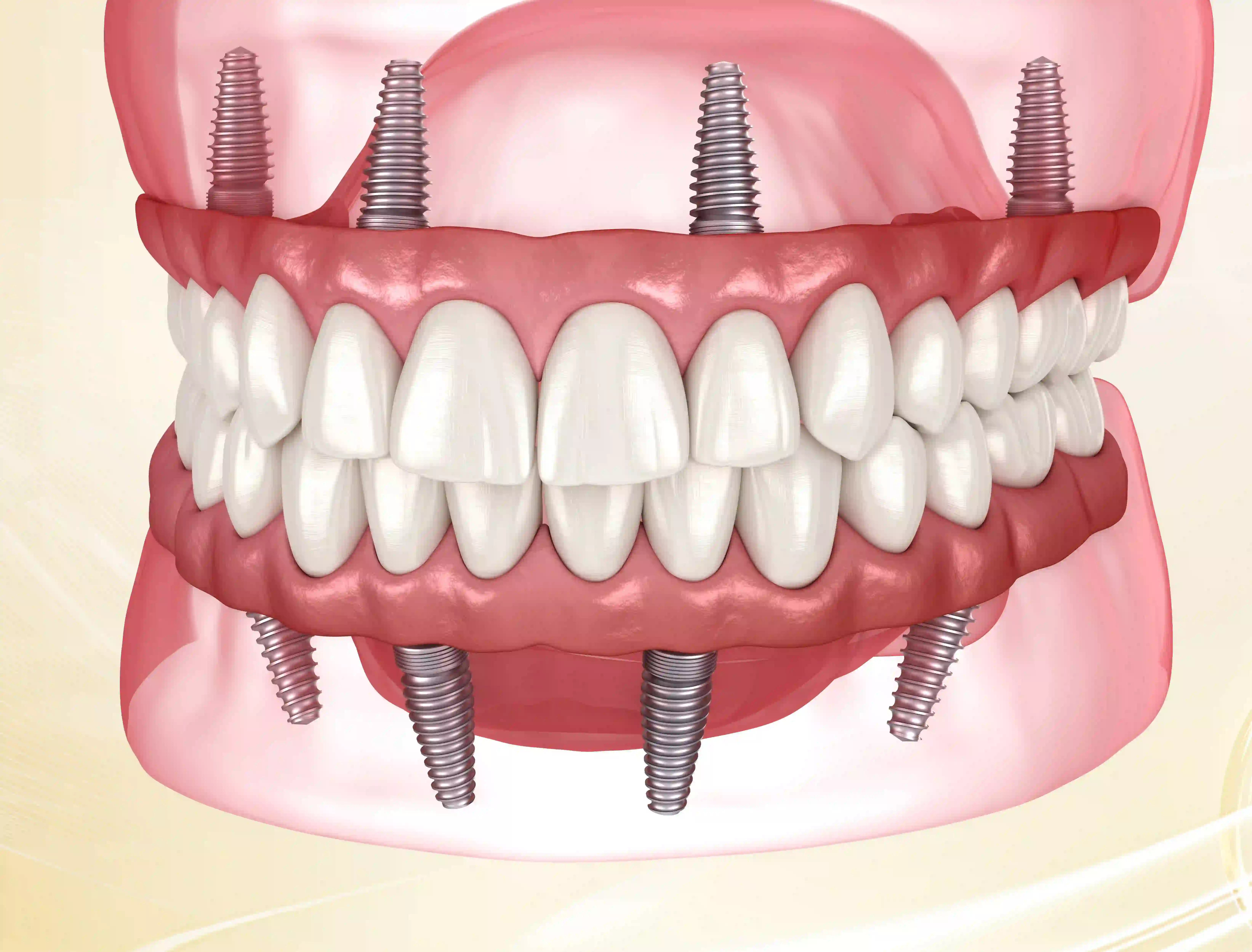 All-on-4 / All-on-6: Kỹ Thuật Y Khoa Đột Phá Cho Người Mất Răng Toàn Hàm